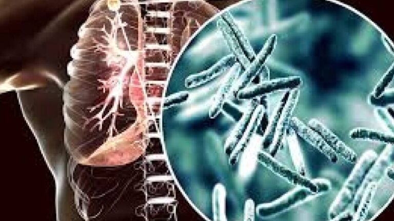 Casos de tuberculosis en Misiones