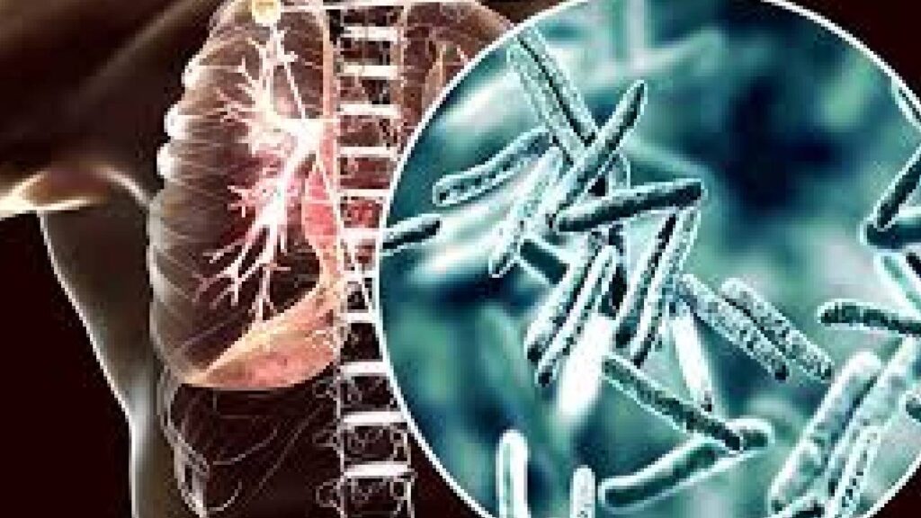 Casos de tuberculosis en Misiones