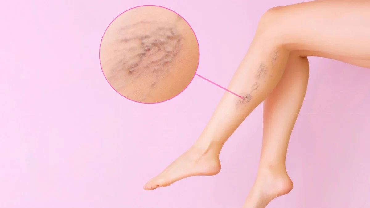Qué son las várices y las arañitas y cuáles son los mejores tratamientos
