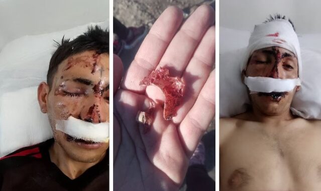 Dos hermanos golpearon a un joven hasta desfigurarlo