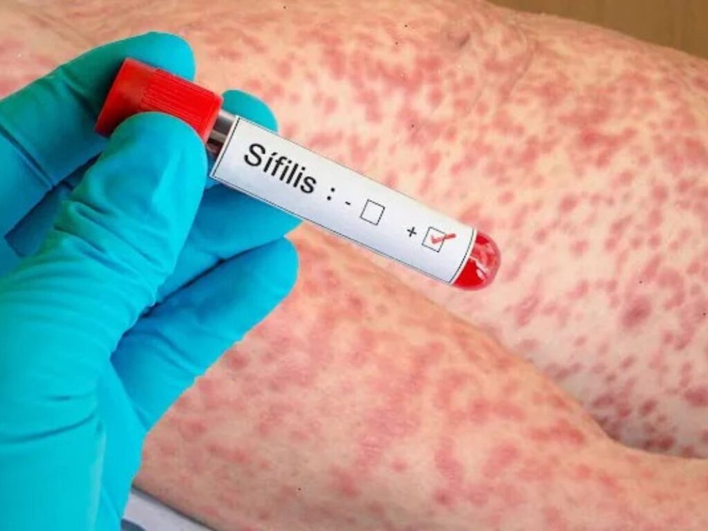 Alertan por el aumento de enfermedades de transmisión sexual en Misiones