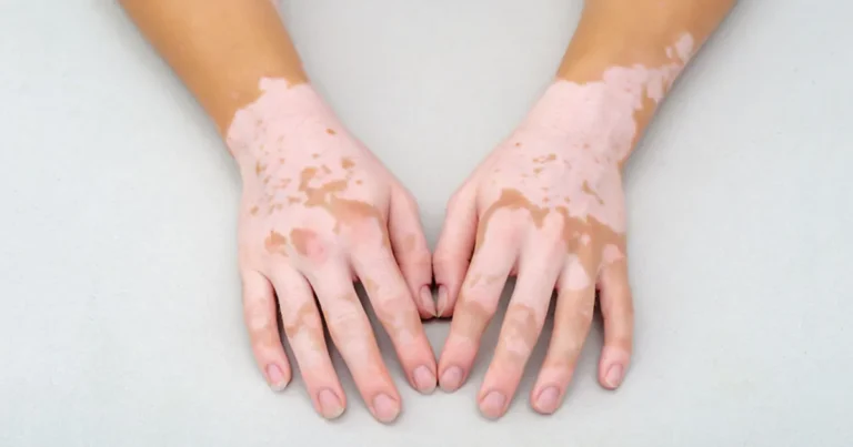 Día Mundial del Vitiligo