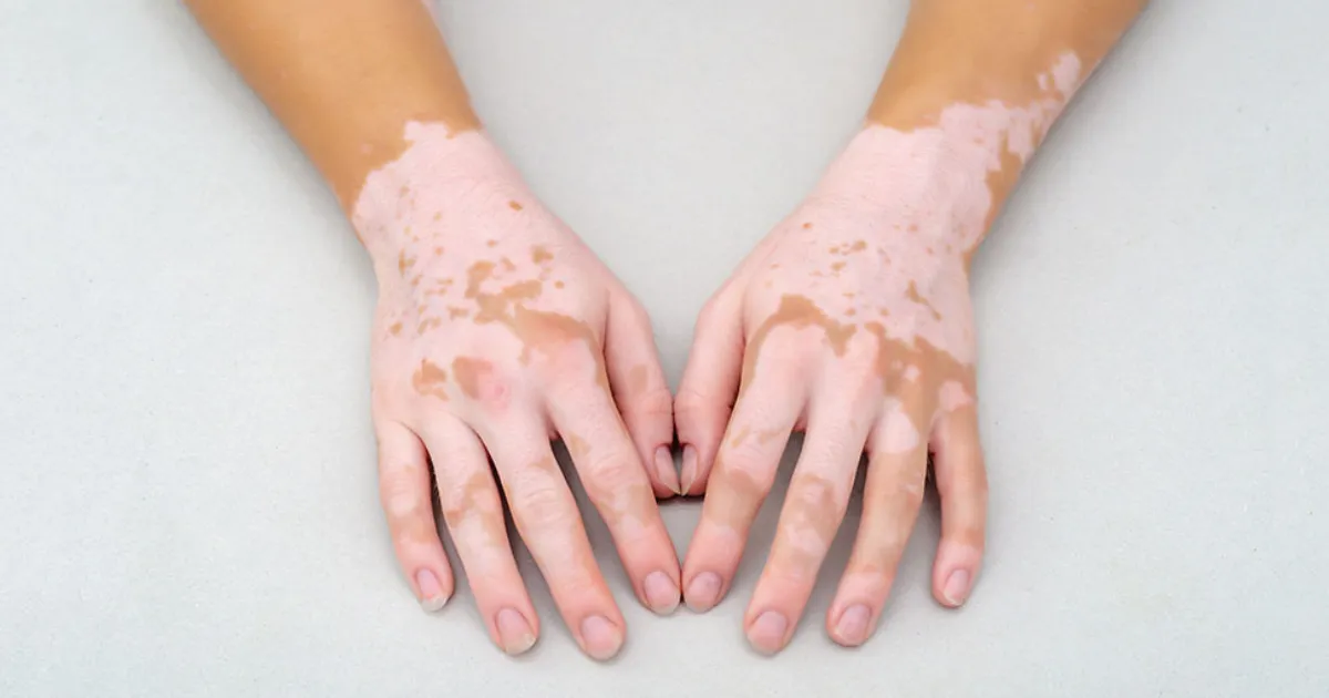 Día Mundial del Vitiligo